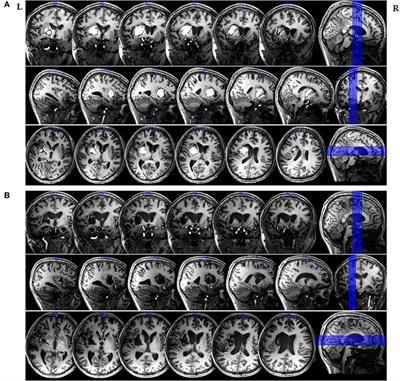 Spontaneous Recovery from Unresponsive Wakefulness Syndrome to a Minimally Conscious State: Early Structural Changes Revealed by 7-T Magnetic Resonance Imaging